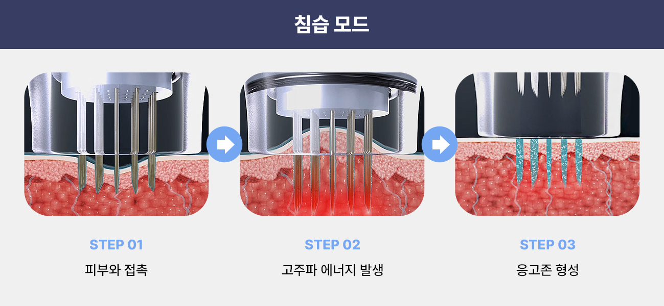 1개 라인만 조사하는 다른 하이푸 장비와 달리 2개 라인으로 된 어플리케이터로 조사 하기 때문에 얇거나 국소 부분까지 피부표면 손상없이 탄력 개선에 도움을 받을 수 있습니다.